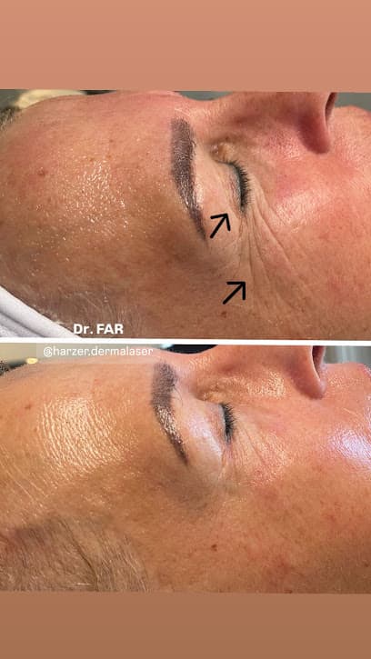 Harzer DermaLaser | Dr.FAR LaserLounge & Healthcare